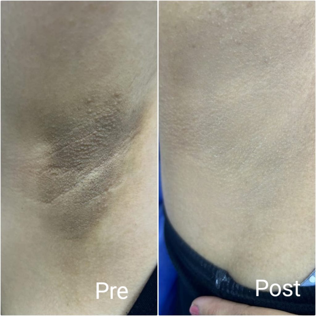 جلسات تفتيح البشرة في الغردقة